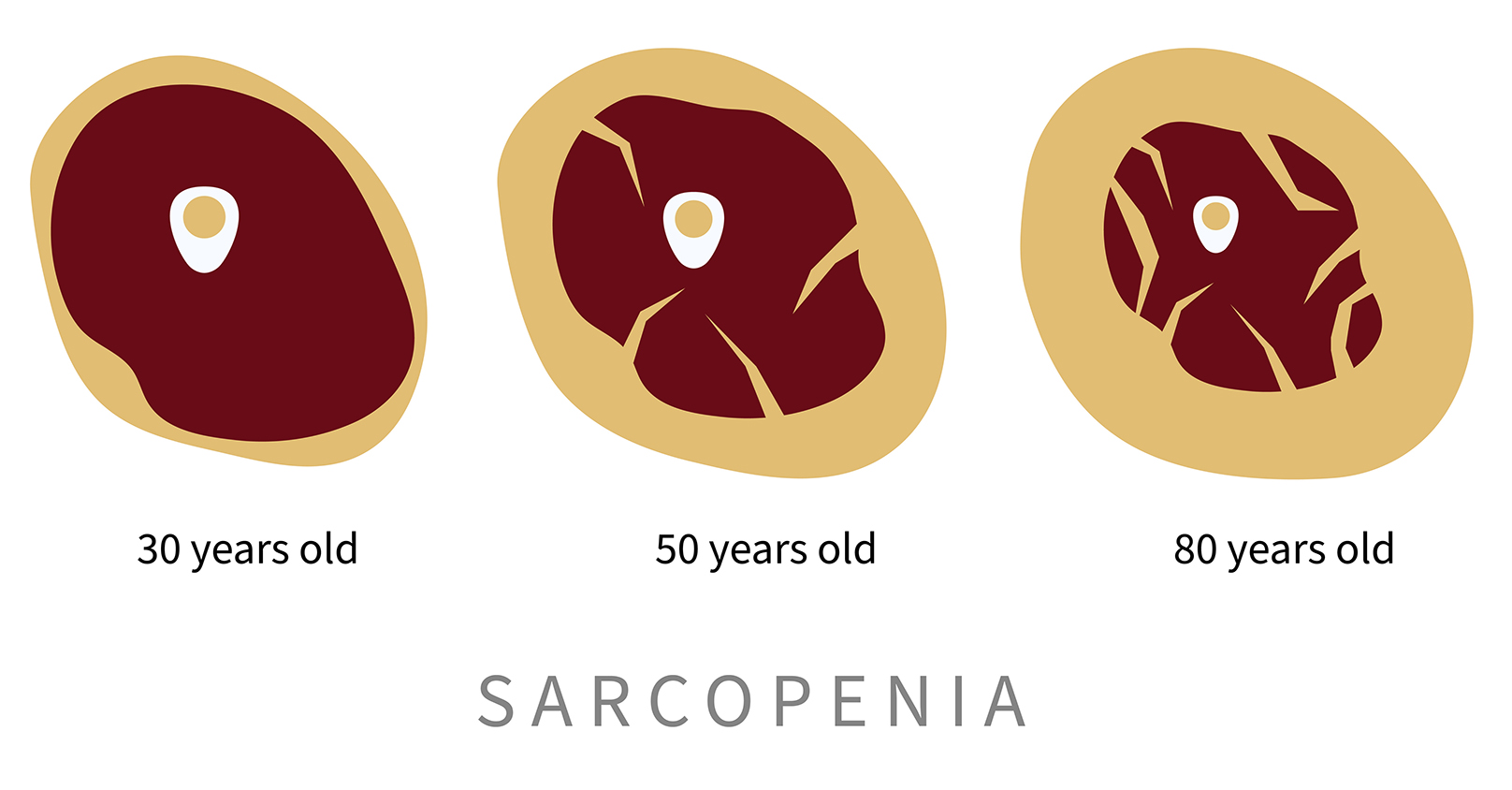 sarcopenia diagram